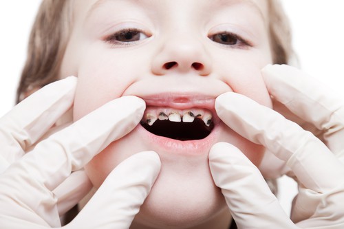 Próchnica zębów - choroba stara jak świat