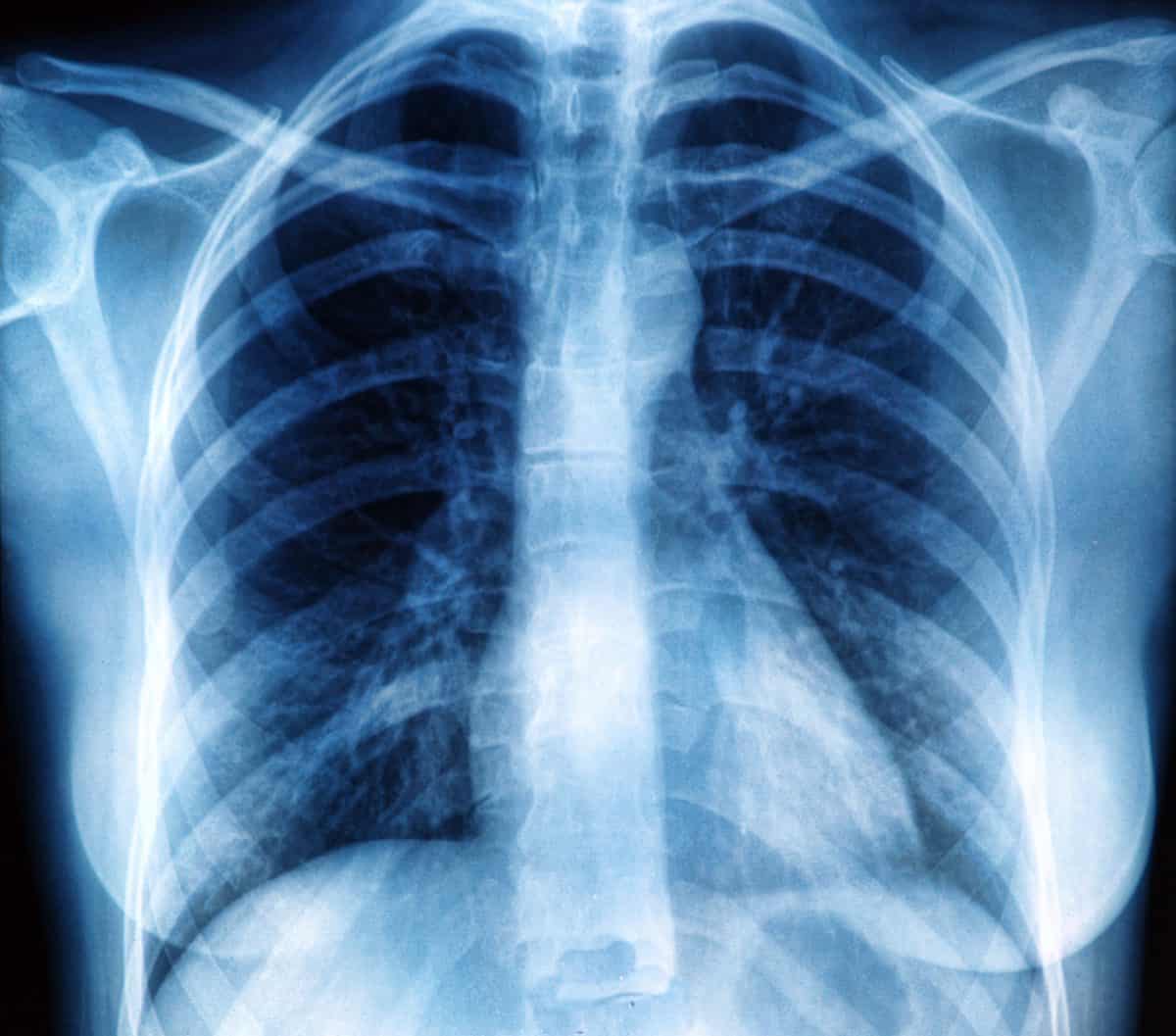 Rentgen płuc - podstawowa metoda diagnostyczna chorób płuc